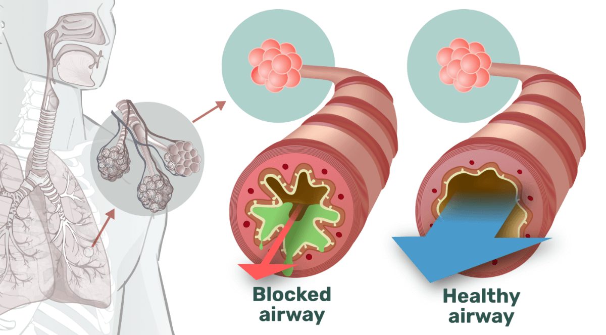 Illustration comparing a mucus-blocked airway with a clear, healthy airway